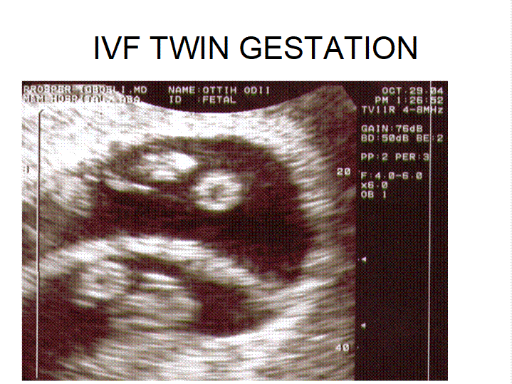 Ultrasound scan tracking early gestational sac and endometrial thickness