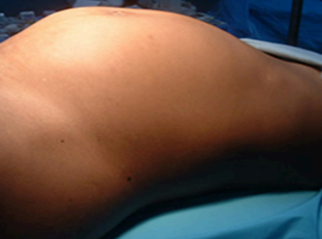 Intra-operative view of a heavily fibroid-laden uterus in situ