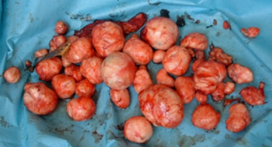 Enucleated fibroids immediately after dissection