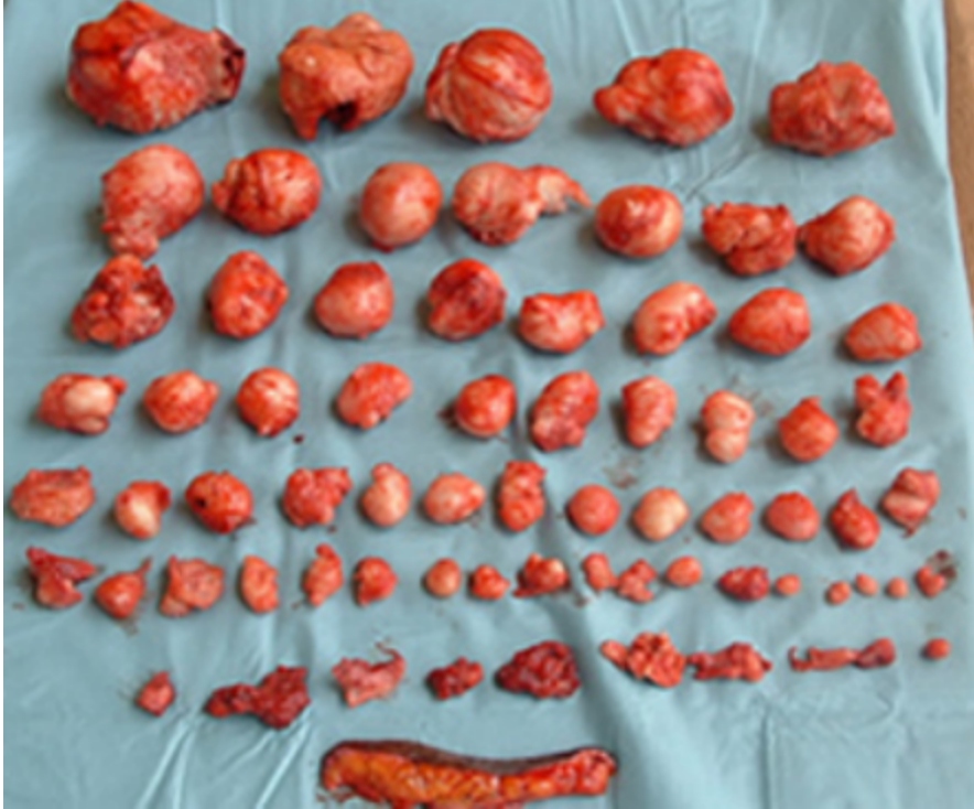 Complete row arrangement of all enucleated fibroids removed from a single patient